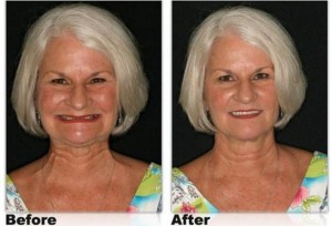 denture-before-and-after